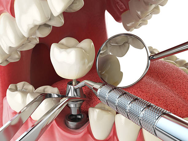 Best Broken or Cracked Tooth Emergency Dentist in Roosevelt, NJ